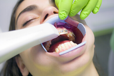 Teeth Braces